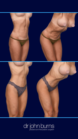 Mini Tummy Tuck- Dallas Mini Tummy Tuck by Dr. John Burns in Dallas, Texas.png__PID:2450b10c-7bb5-4ea7-9360-e464872ac935