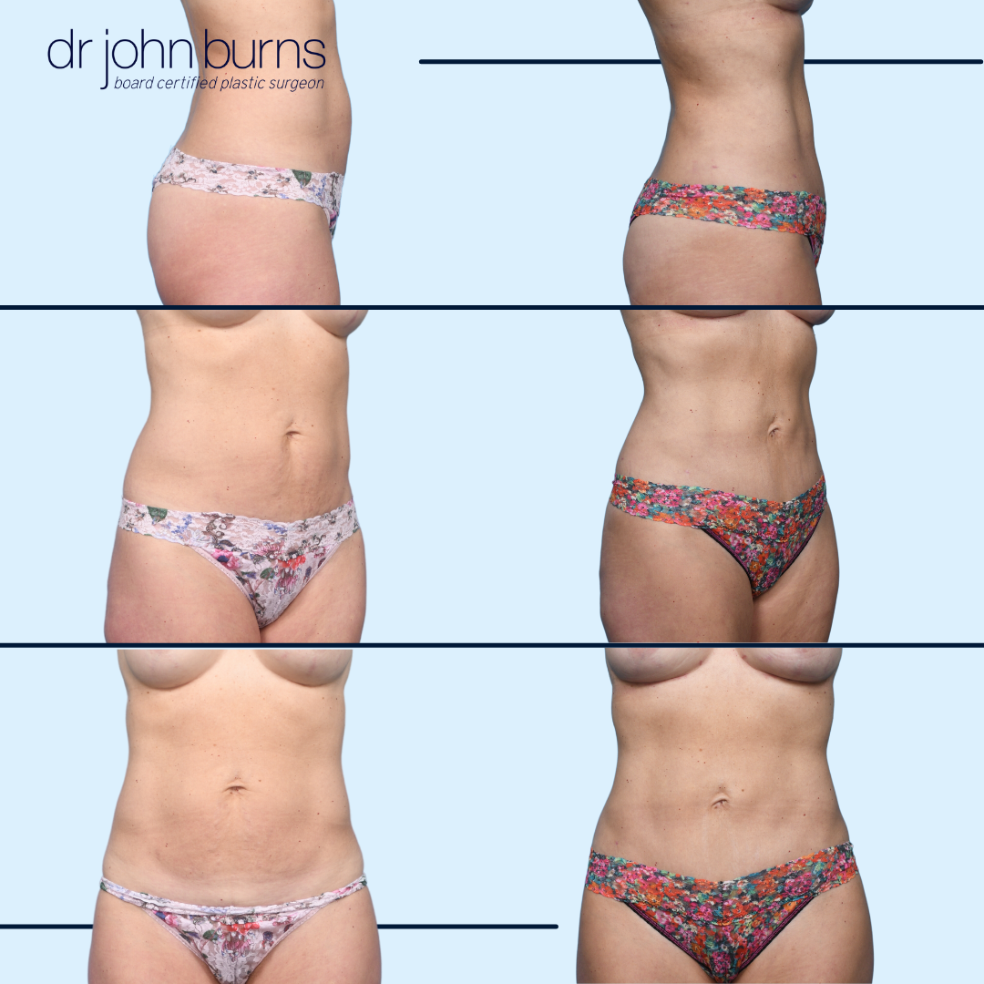 Mini Tummy Tuck Before and After in Dallas, Texas- Dr. John Burns MD.png__PID:872ac935-8c7e-48d6-921d-017d1f6968a4