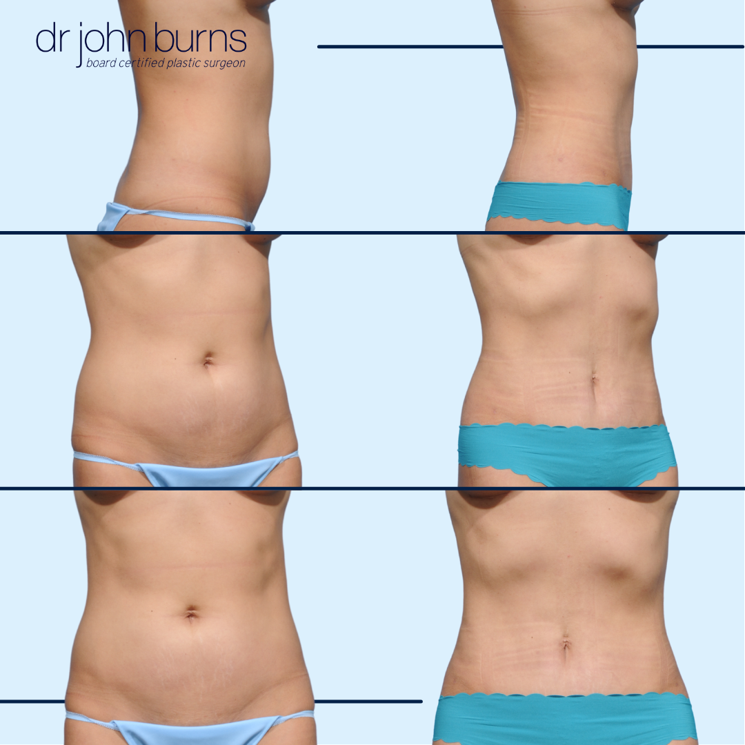 Mini Tummy Tuck Before and After in Dallas Texas by Dr. John Burns MD- Top Surgeon.png__PID:c9358c7e-88d6-421d-817d-1f6968a4232e
