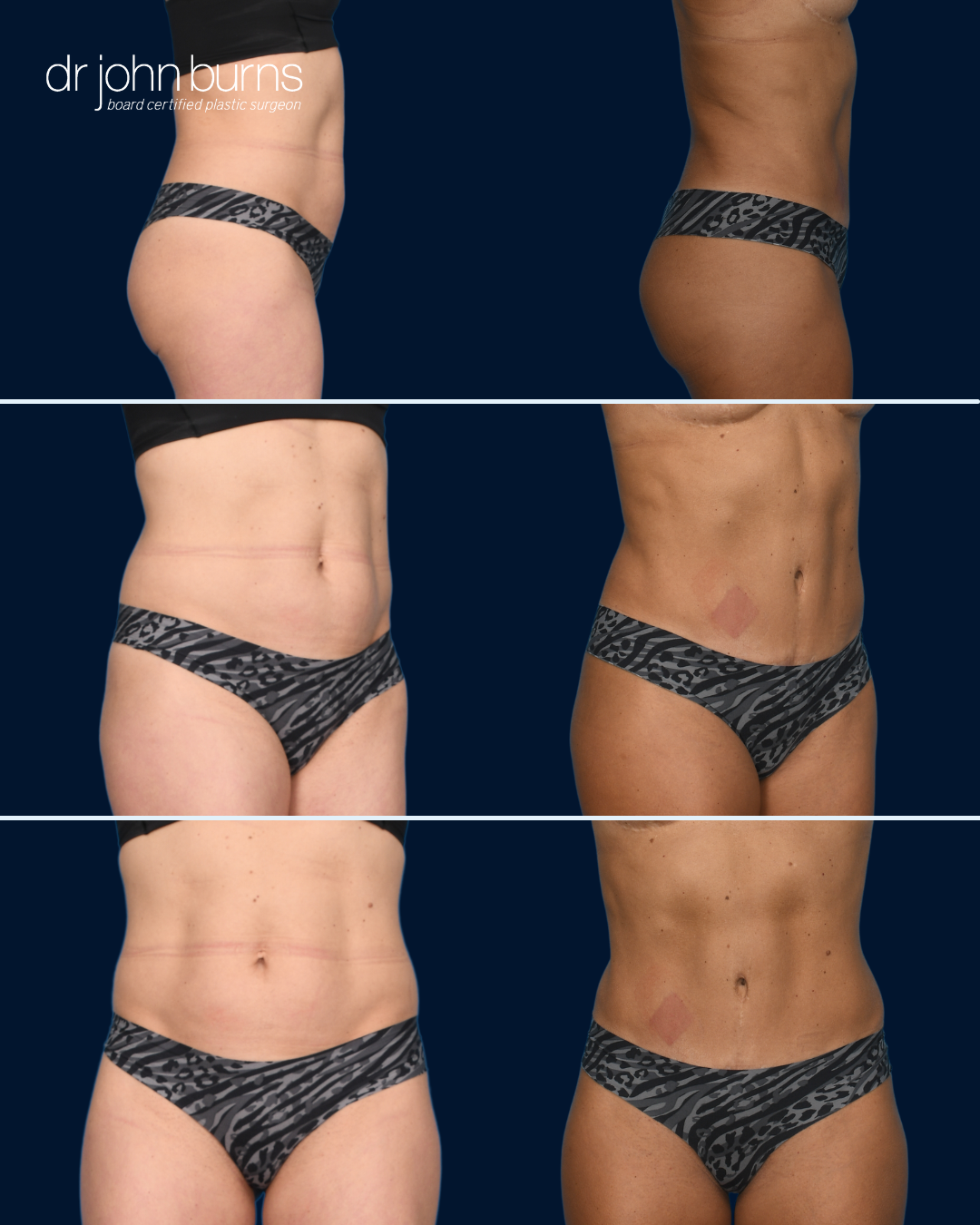 Mini Tummy Tuck with Floating The Belly Button.png__PID:e4fbf4b8-bbb6-47e7-8449-b87bf753976d