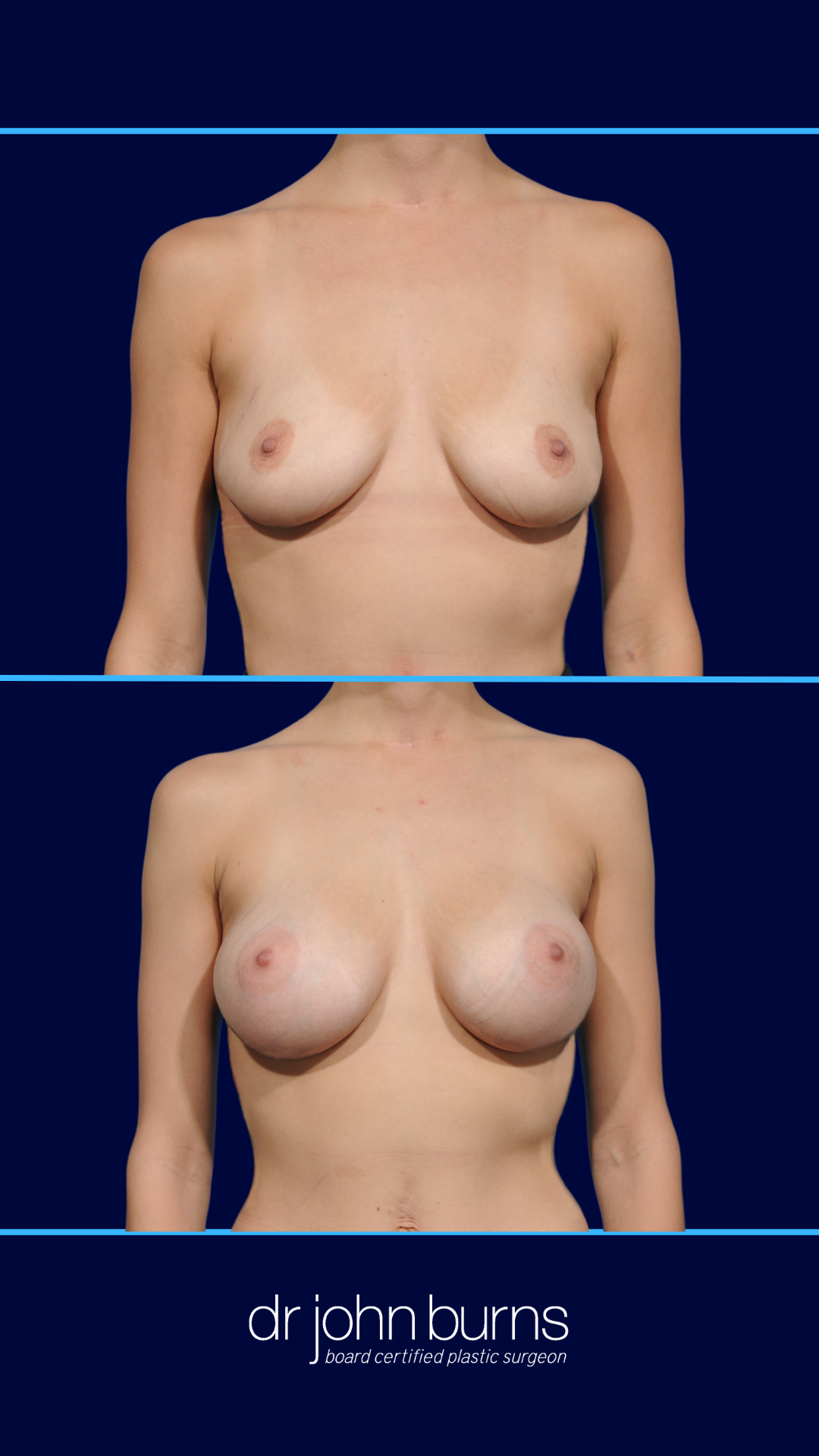 Mommy Makeover Breast Augmentation- Dr. John Burns- Dallas, Texas.png__PID:7c28bd95-355e-4774-94e8-347c5a6f1439