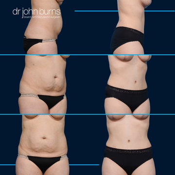 How To Get a Snatched Waist: Liposuction vs Tummy Tuck