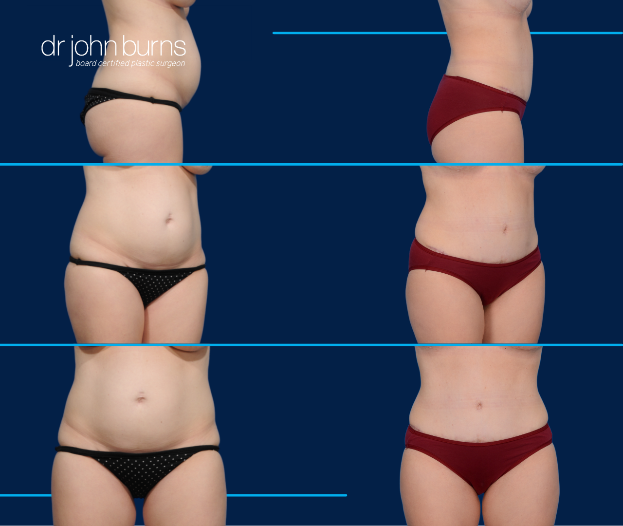 Before and after tummy tuck by Dallas Tummy tuck expert, Dr. John Burns
