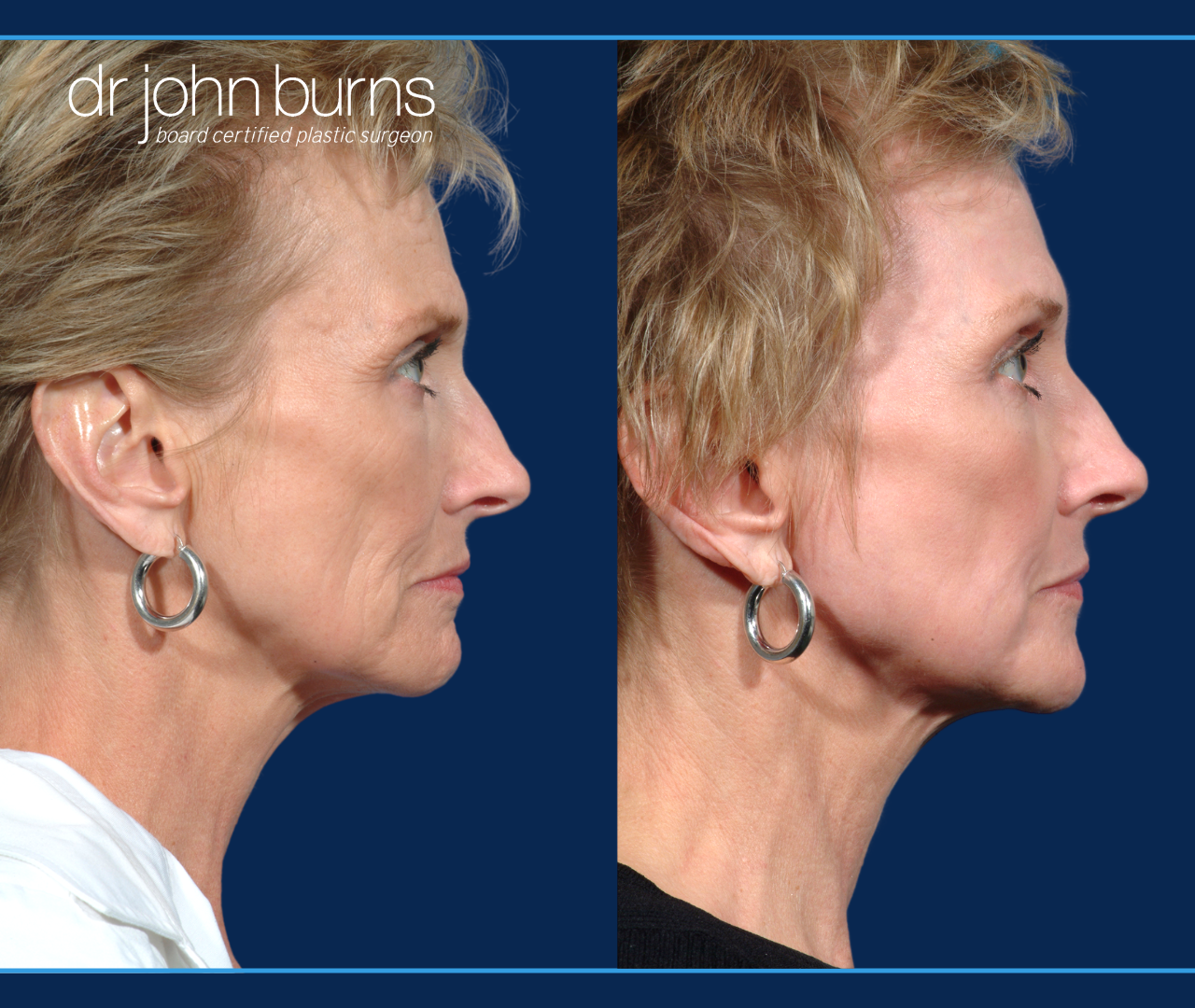 Profile View | Before and after laser skin resurfacing by Dr. John Burns