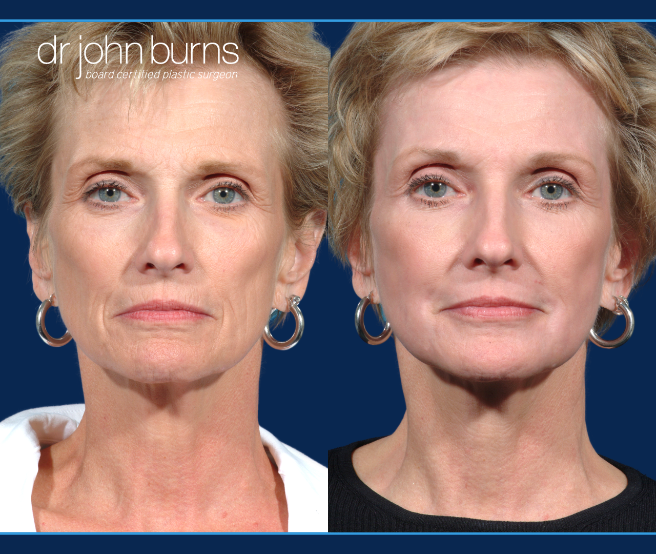 Before and after laser skin resurfacing by Dr. John Burns