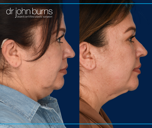 Right profile view | before and after neck lift in dallas, texas