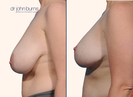 Before and after breast lift with scars