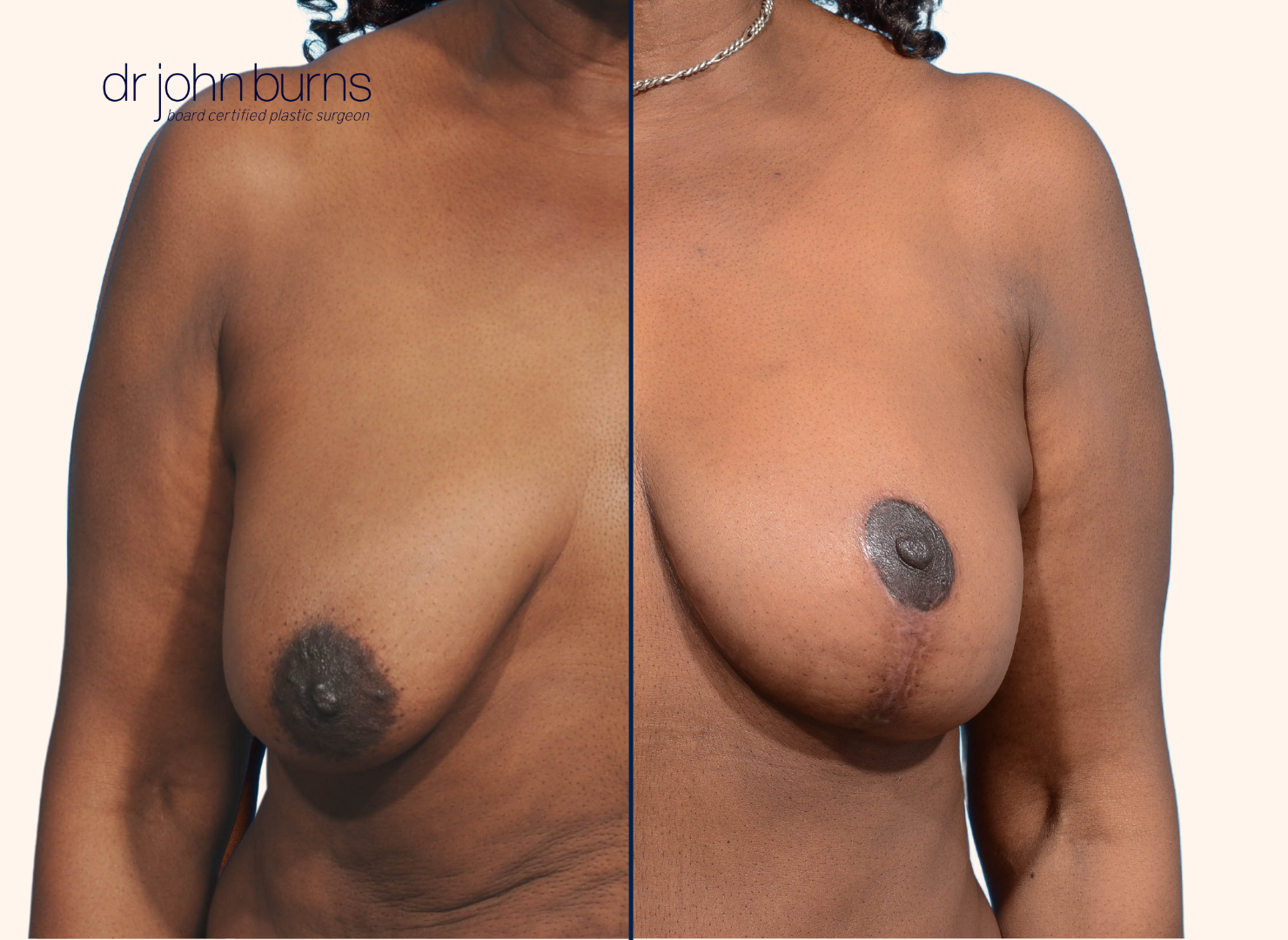 Before and after breast lift with scars