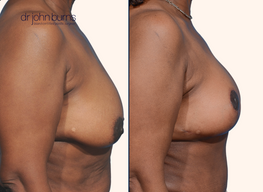 Before and after breast lift with scars by Dr. John Burns