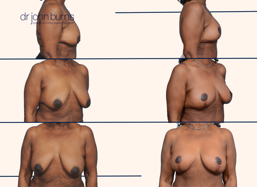 Before and after breast lift with scars