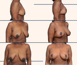 Before and after breast lift by Dallas plastic surgeon, Dr. John Burns