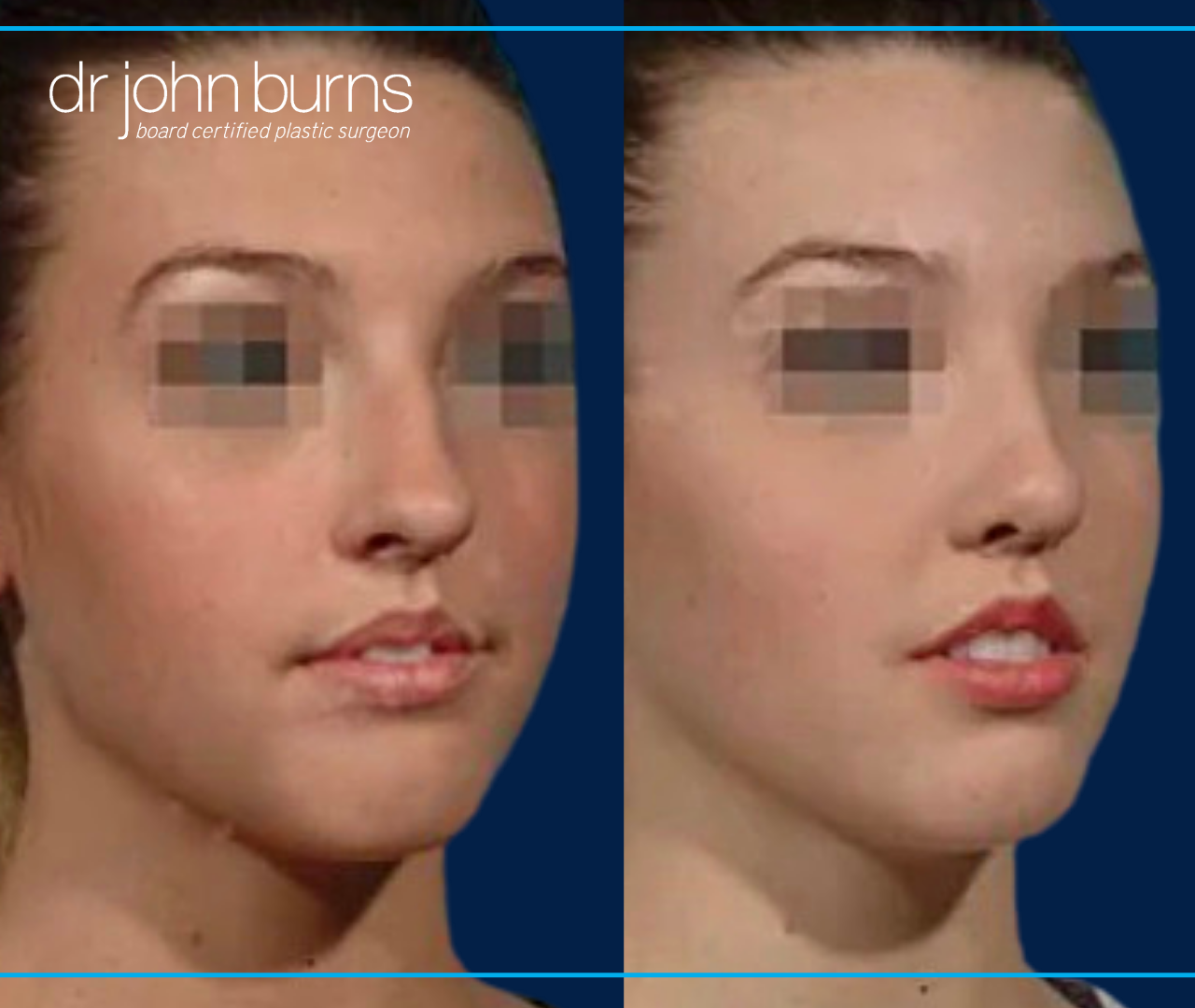 45 Degree View | Before and After Female Rhinoplasty by Dr. John Burns