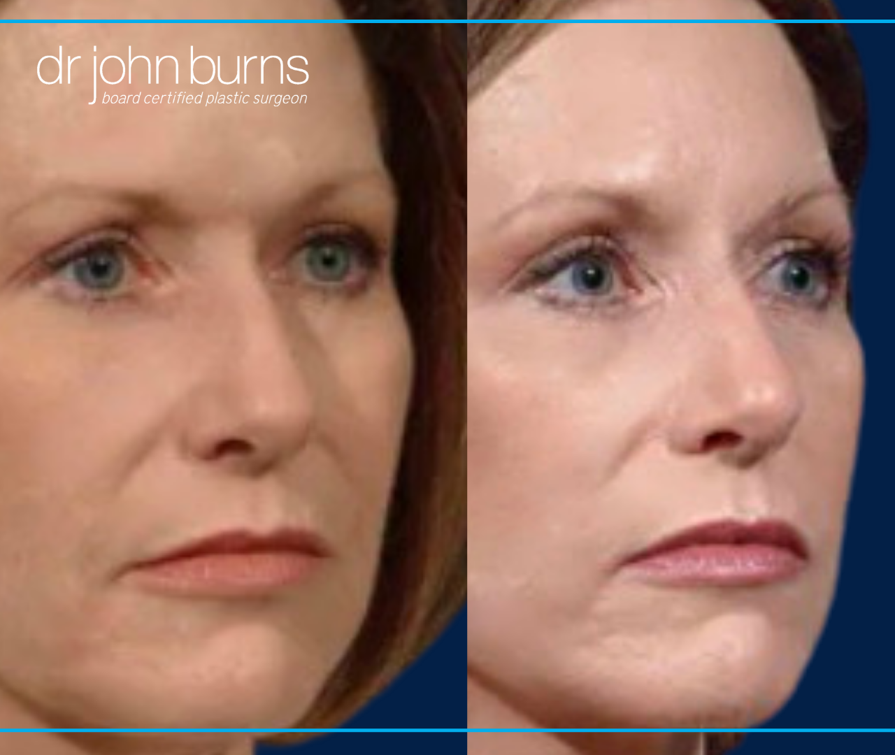 45 Degree View | Before and After Female Rhinoplasty by Dr. John Burns