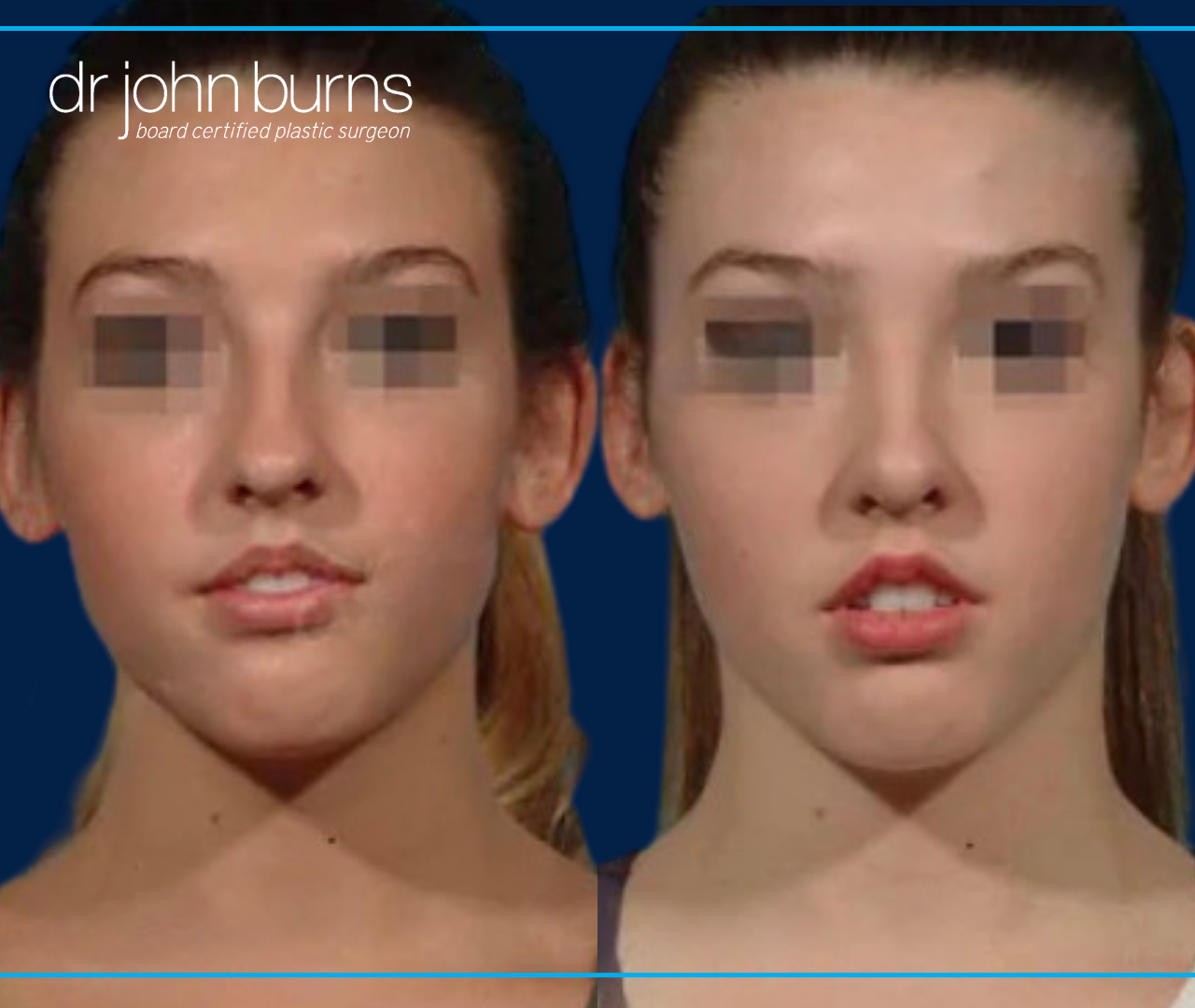 Front Facing View | Before and After Female Rhinoplasty by Dr. John Burns