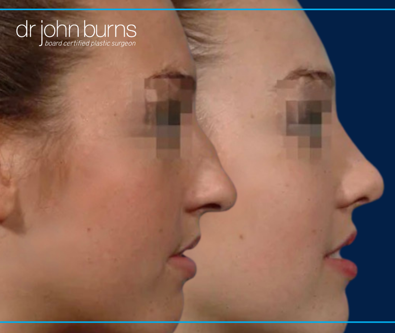 Profile view | before and after dorsal hump correction, nose job results by Dr. John Burns