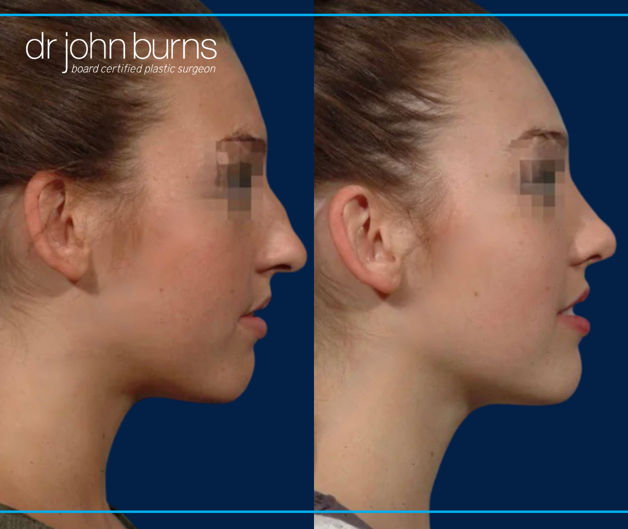 Profile View | Before and After Female Rhinoplasty by Dr. John Burns