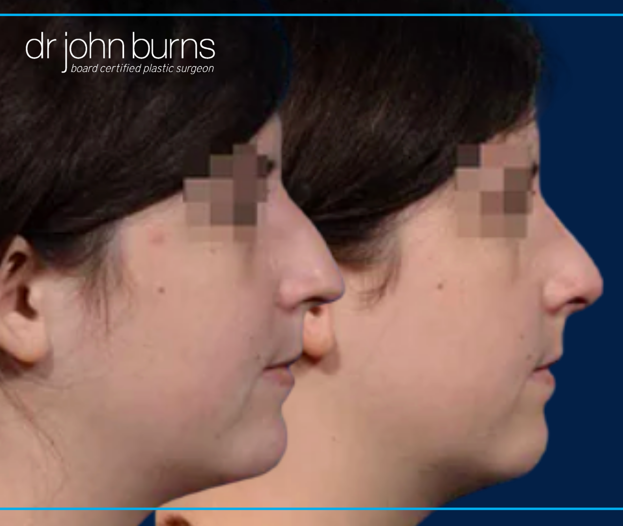 Profile View | before and after nose job results by Dr. John Burns