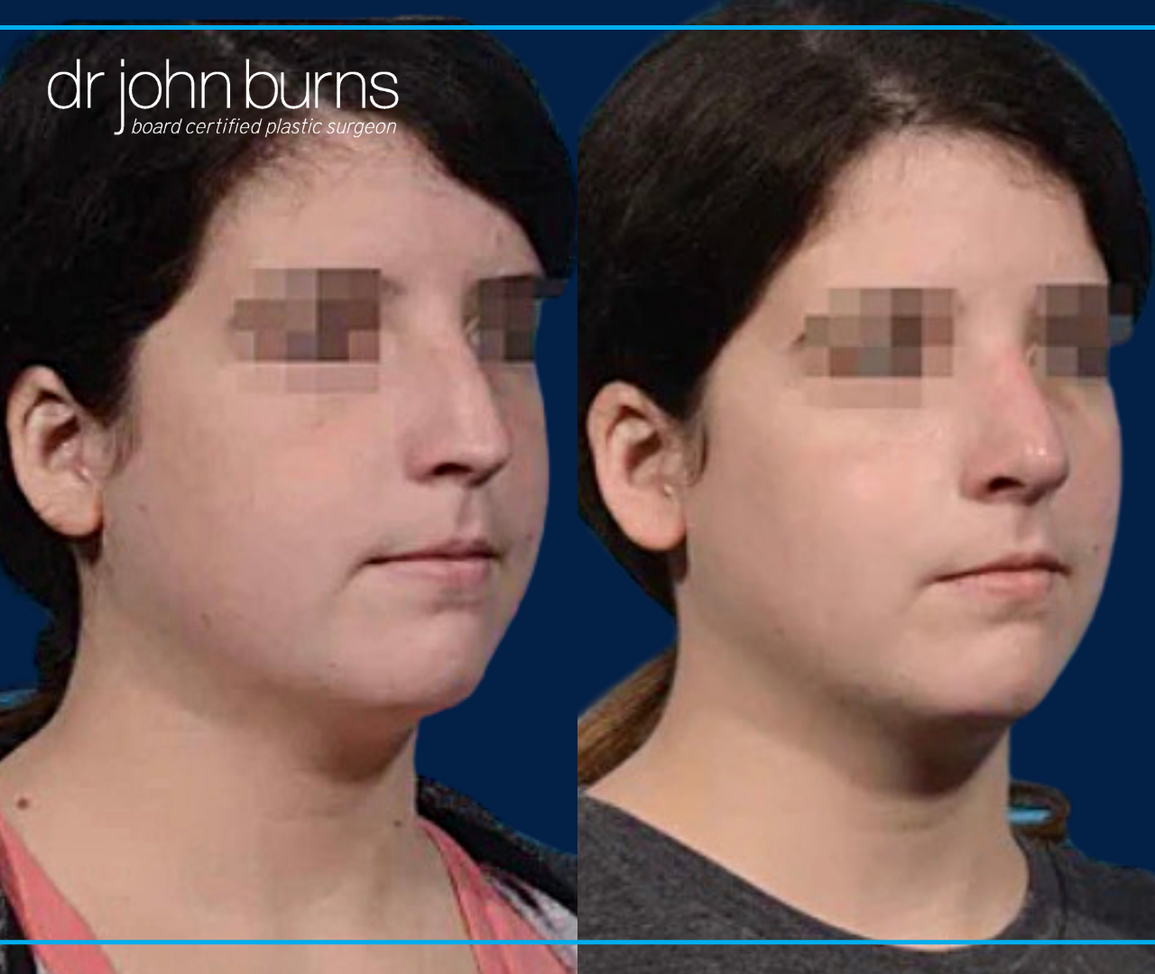 45 Degree View | Before and After Female Rhinoplasty by Dr. John Burns