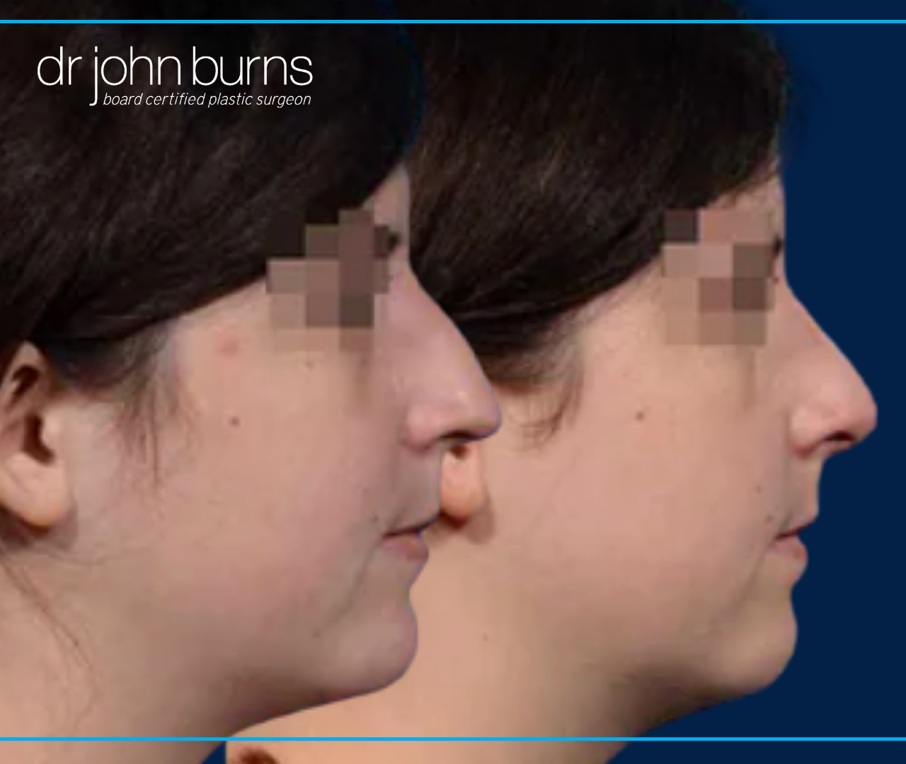 Before and After Rhinoplasty in Dallas by Dr. John  Burns 