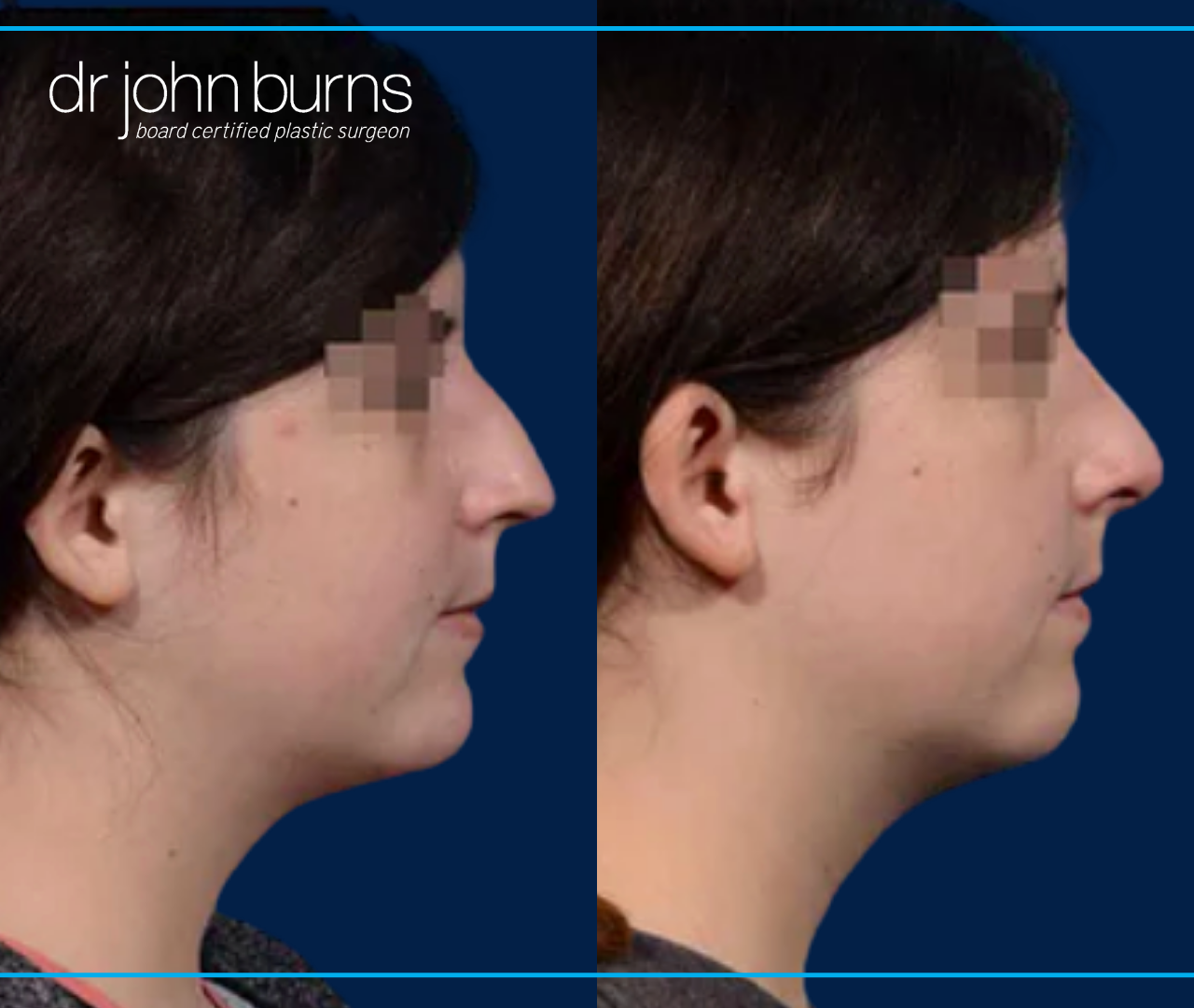 Profile View | Before and After Female Rhinoplasty by Dr. John Burns