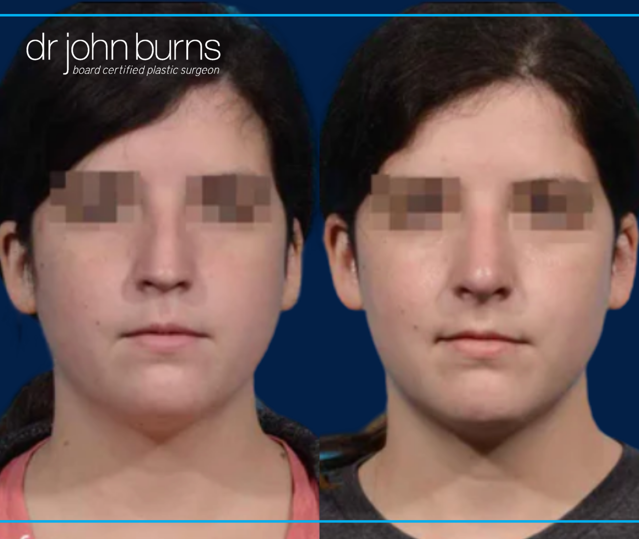 Front Facing View | Before and After Female Rhinoplasty by Dr. John Burns