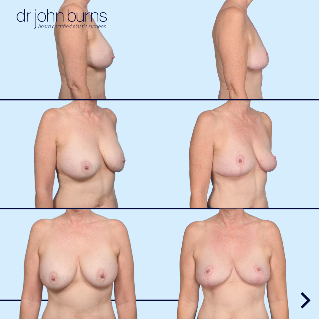 Before and after explant with immediate fat transfer and breast lift by Dallas Plastic Surgeon, Dr. John Burns MD in Dallas, Texas