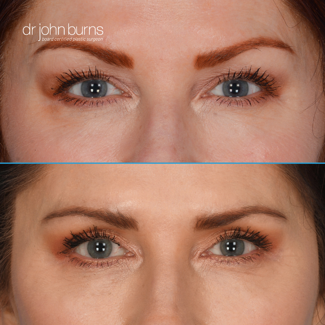 Before and After Eyelid Surgery- Dallas, Texas- Dr. John Burns