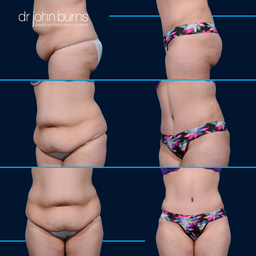 Dallas Mommy Makeover-Extended Tummy Tuck Results- Dr. John Burns – Dr John  Burns