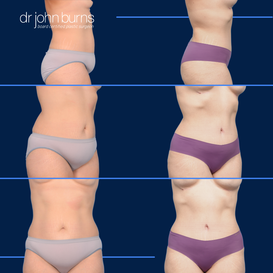 Before and After Liposuction in Dallas, Texas