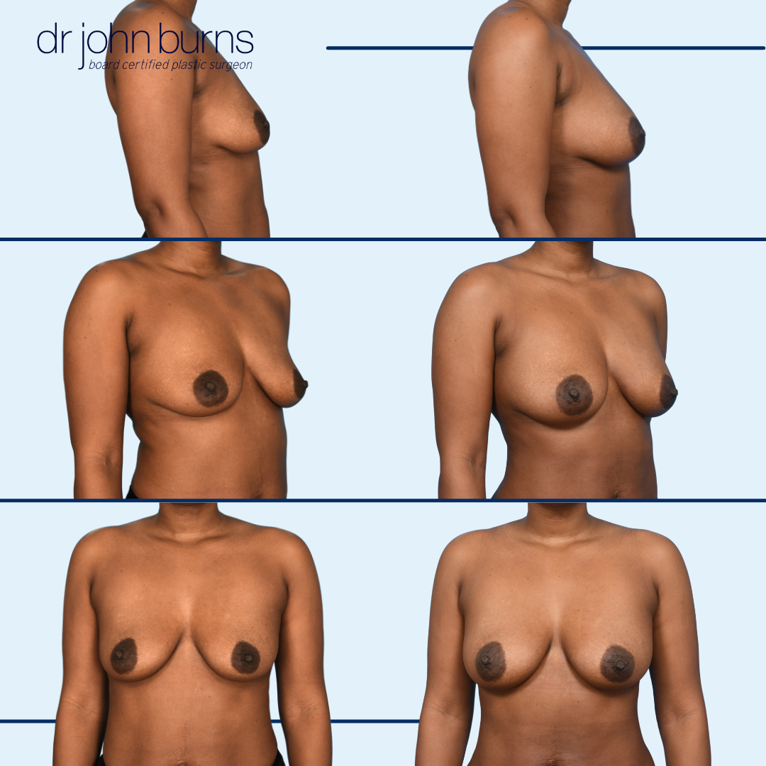 fat grafting to the breasts- Dallas, Texas- Dr John Burns MD