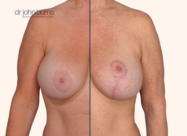 before and after full breast lift by Dr. John Burns