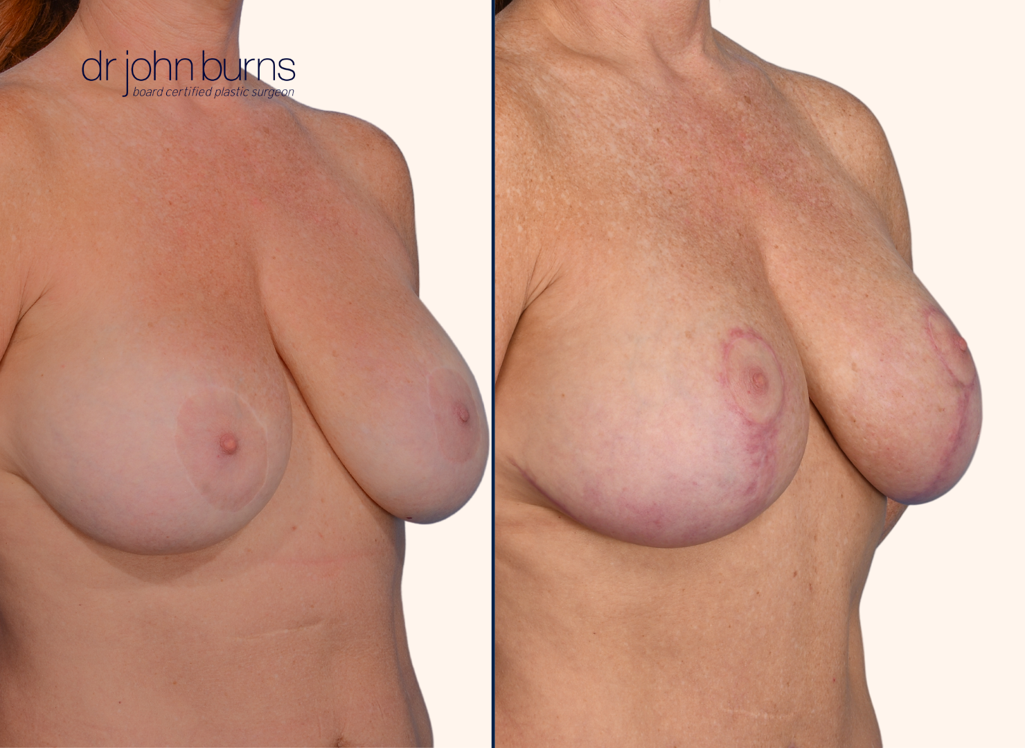 before and after full breast lift by Dr. John Burns