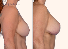 profile view, before and after full breast lift by Dr. John Burns