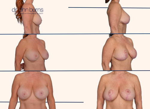 Before and after full breast lift 