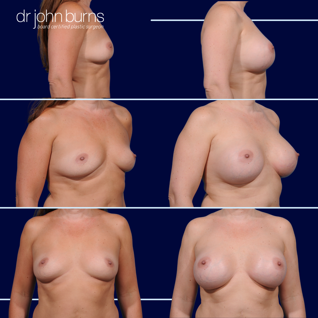 Saline Breast Implants- Before and After- Dr. John Burns.png__PID:9e816d63-13e2-42a1-827b-211159b53a43