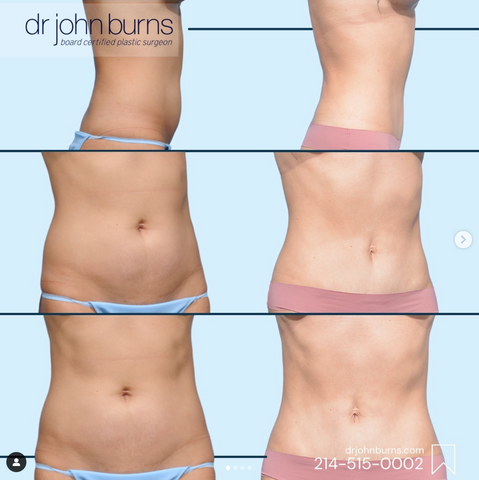Tiny Tuck: Floating the Belly Button: Advanced Techniques – Dr