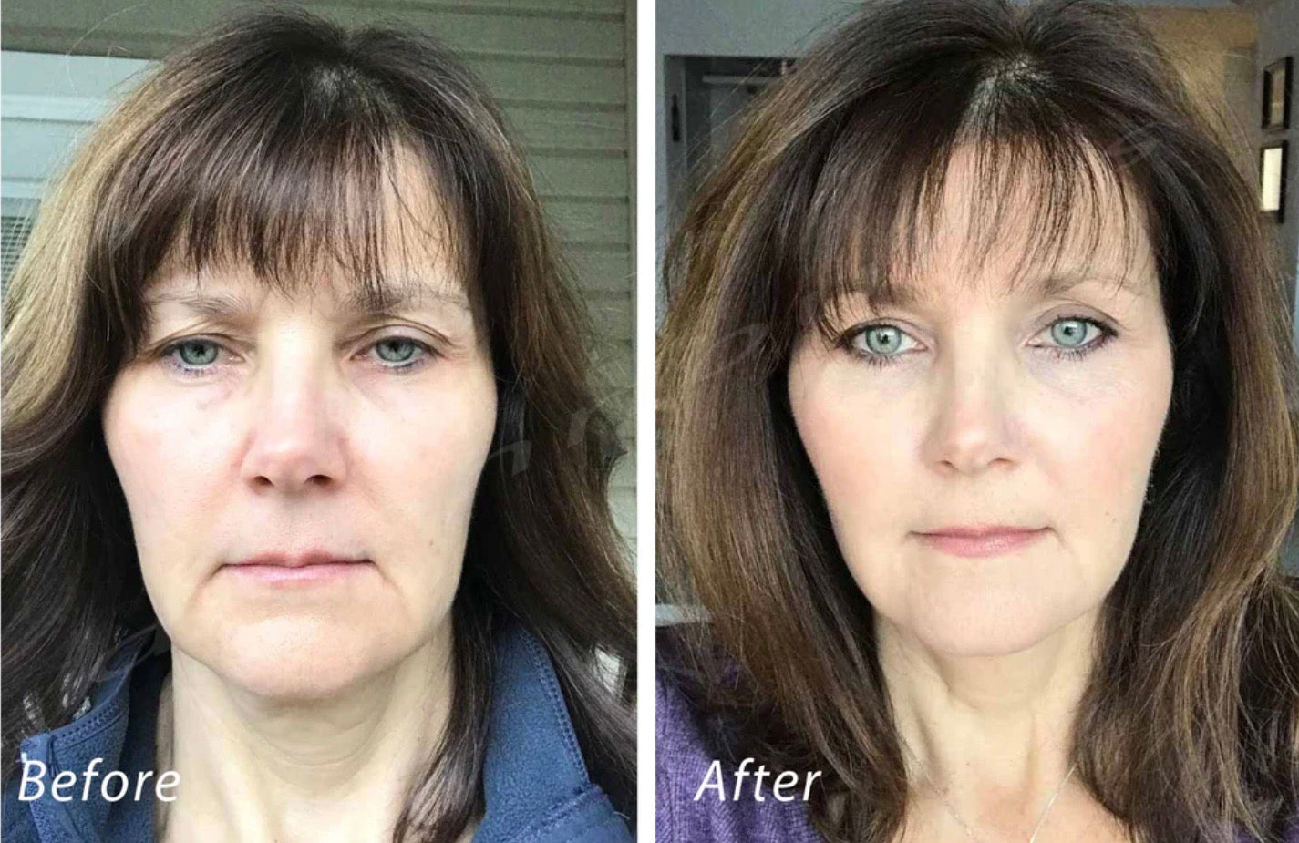 Dr. John Burns Patient | Facial Fat Grafting Before and After