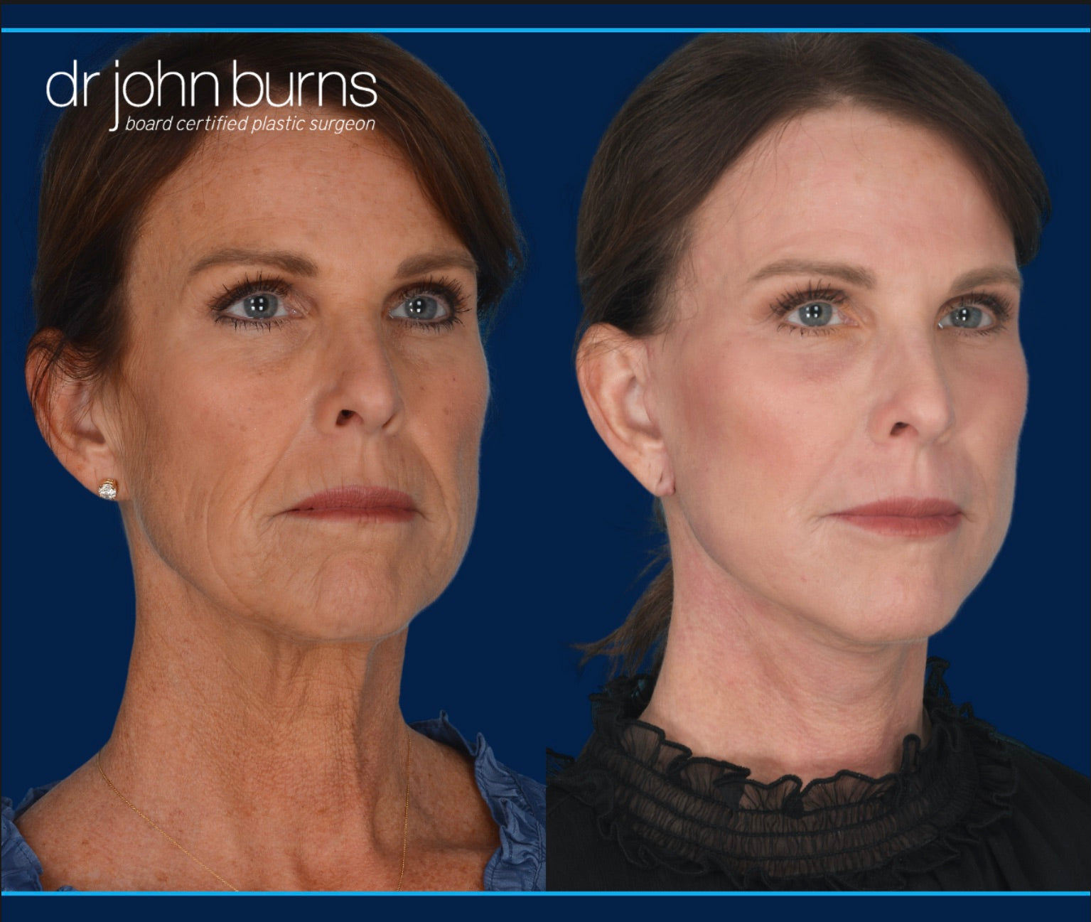 Right 45 Degree View | Before and after laser skin resurfacing by Dr. John Burns