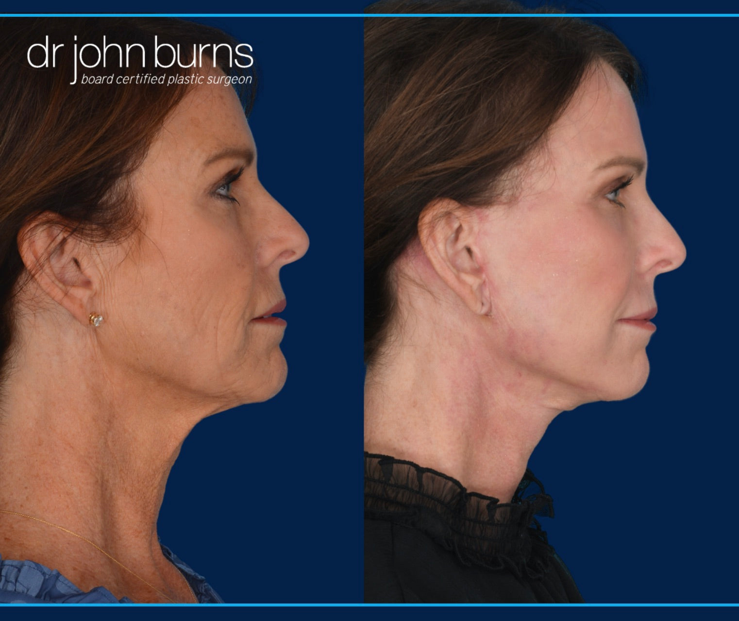 Profile View | BBefore and after laser skin resurfacing by Dr. John Burns