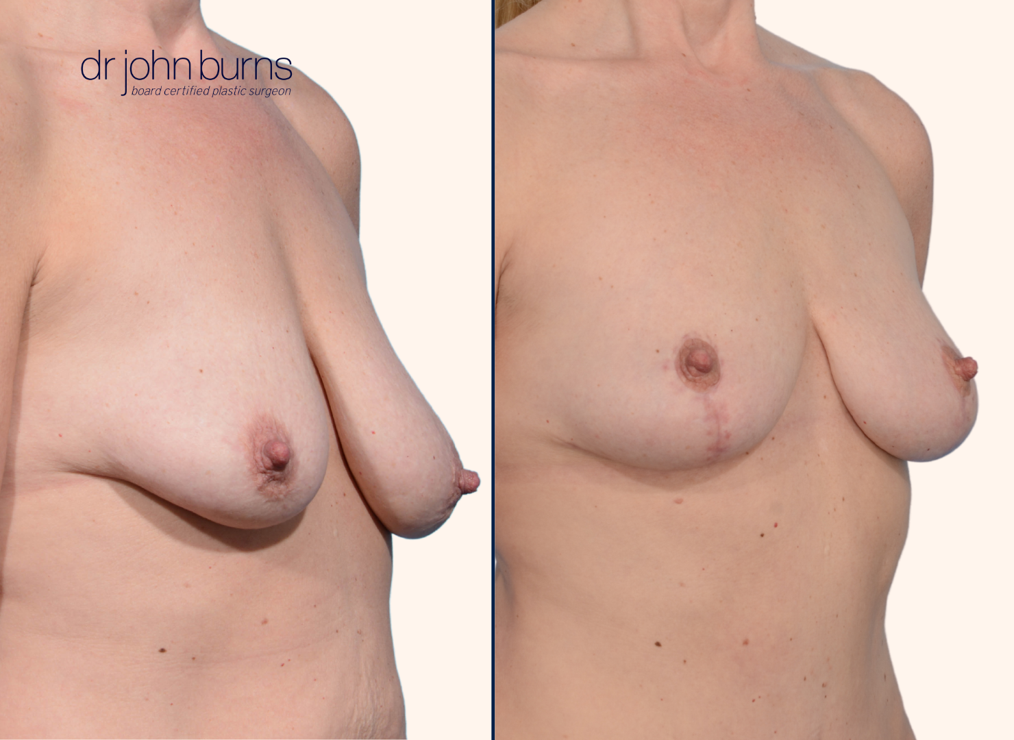 before and after anchor breast lift