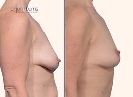 before and after anchor breast lift