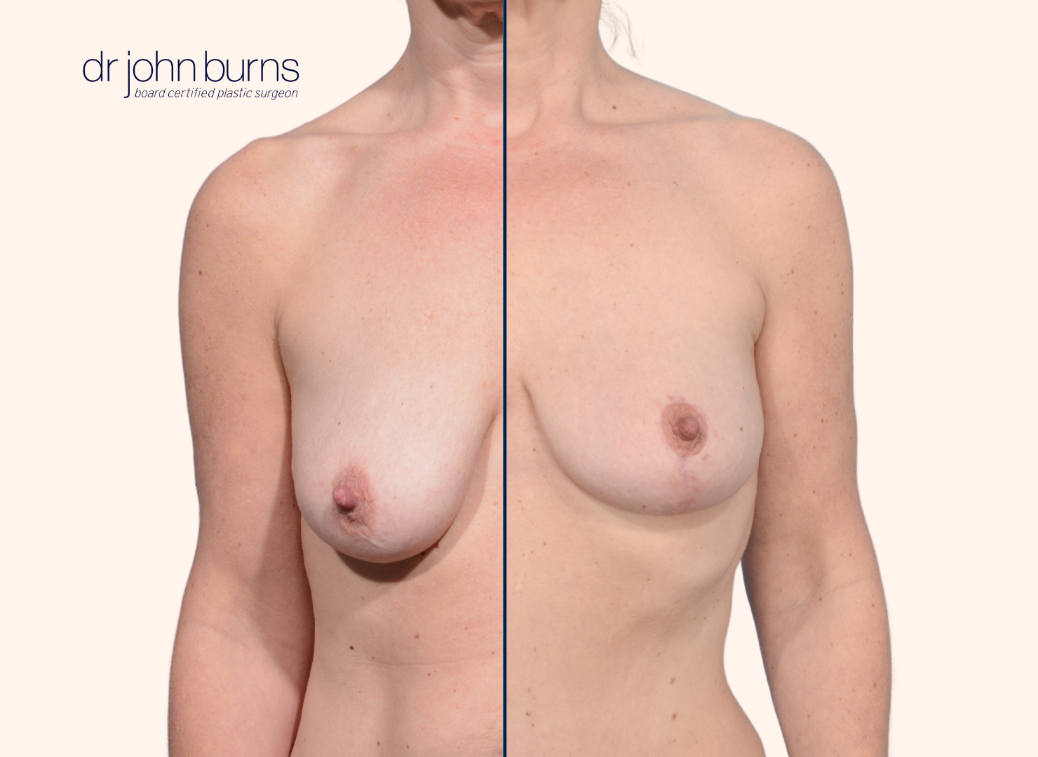 before and after anchor breast lift