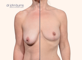 before and after anchor breast lift