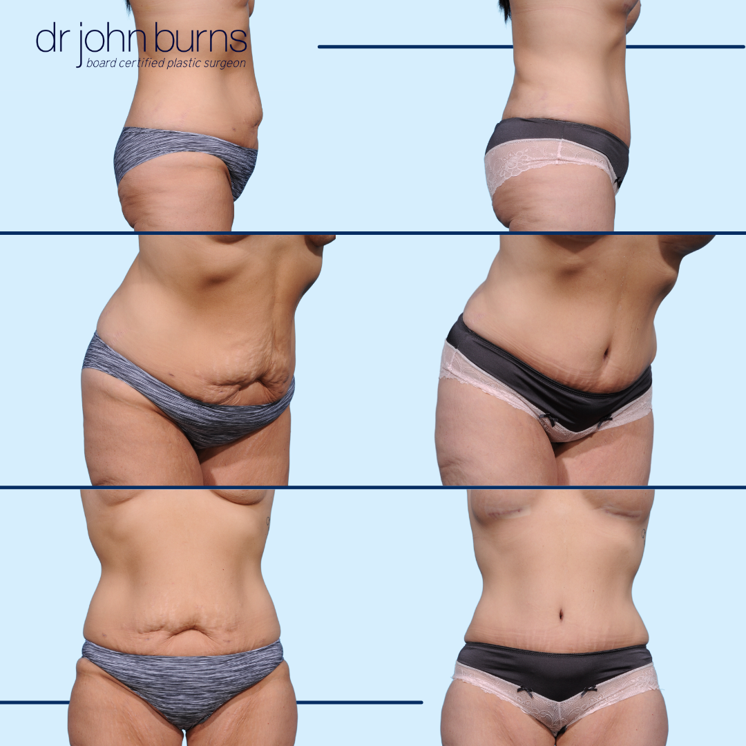 Before and After tummy tuck, Dallas Texas, Dr. John Burns