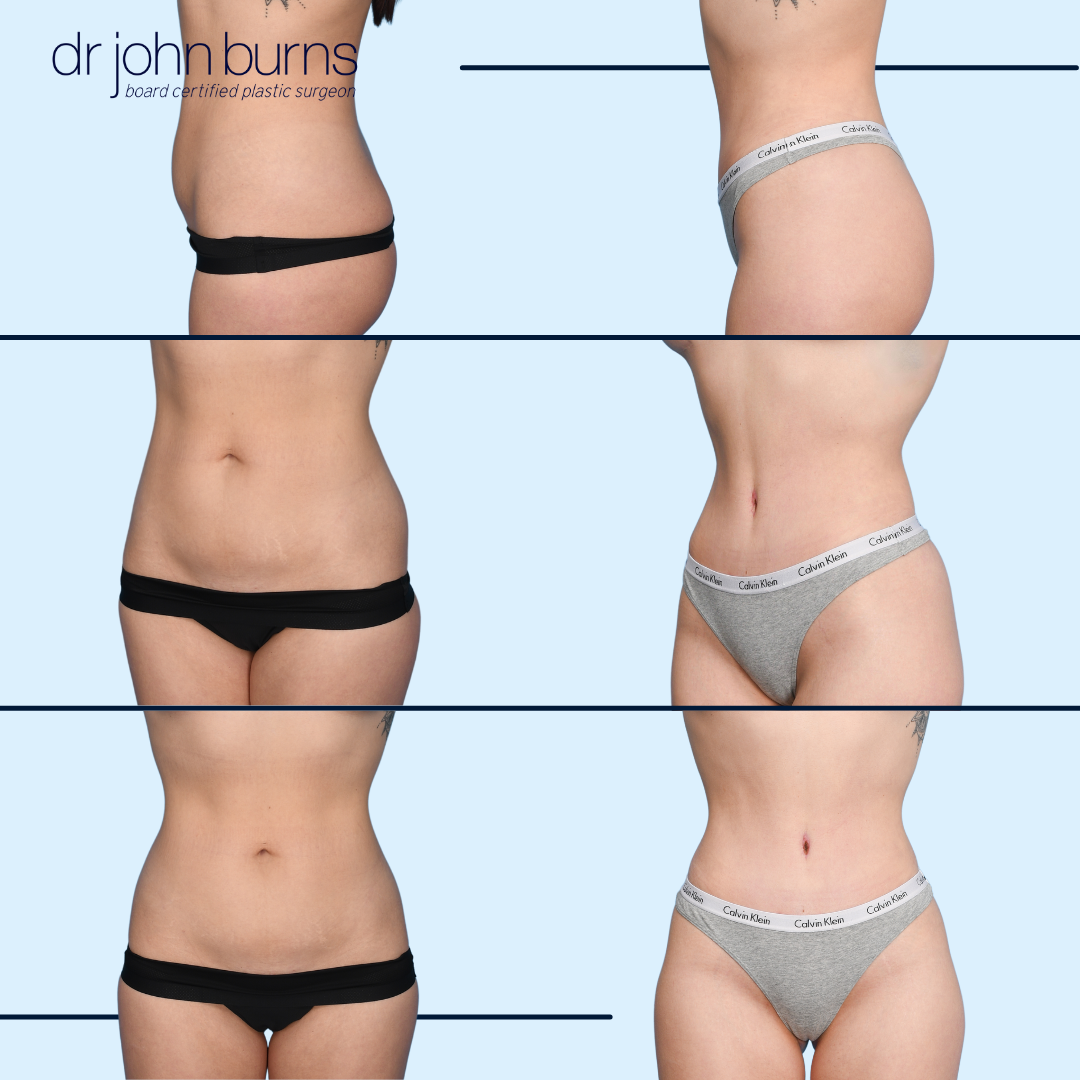 Tummy Tuck Before and After in Dallas, Texas-Best Mommy Makeover Surgeon- Dr. John Burns MD