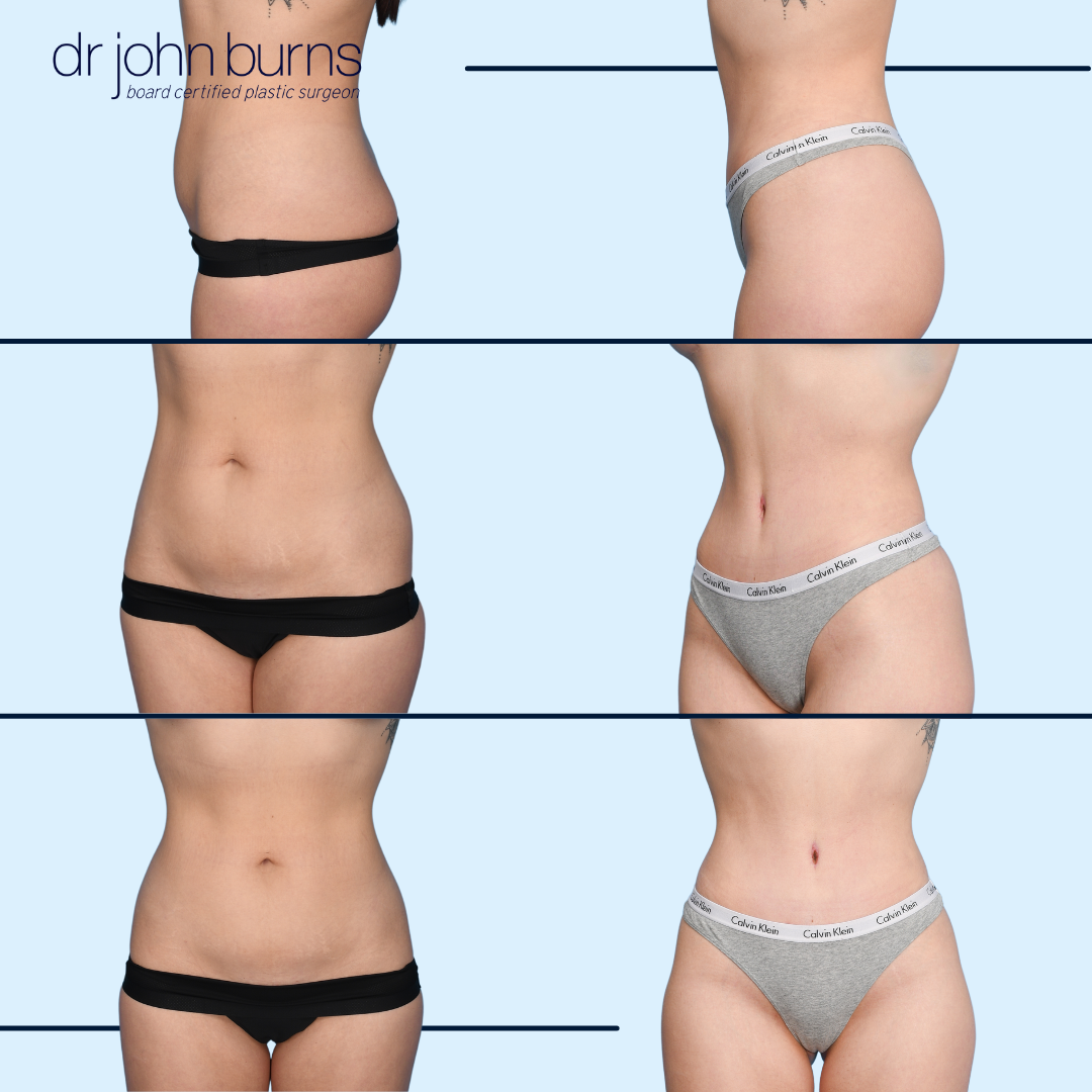 Before and After tummy tuck, Dallas Texas, Dr. John Burns