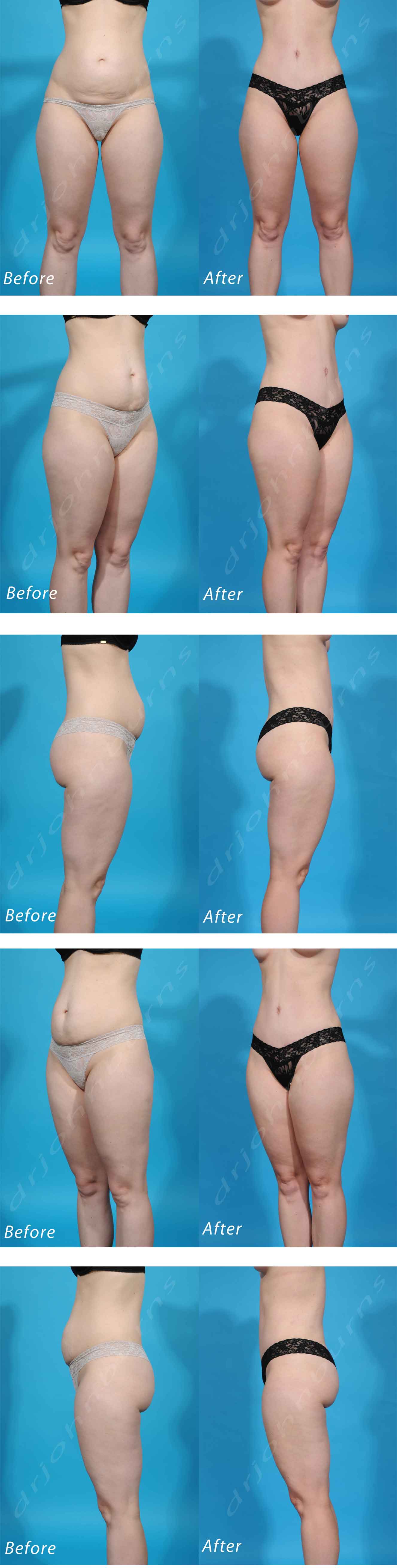 Dr. Trussler Liposuction