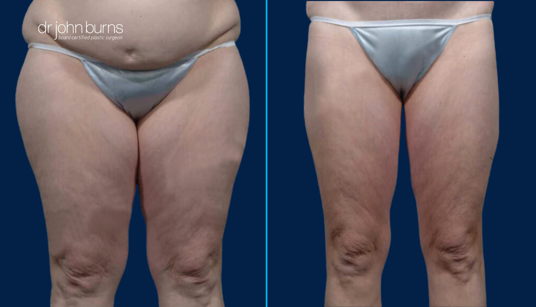 Thigh LIft before and after in Dallas, Texas.png__PID:03fe263d-516d-4b08-8736-373c33387e90