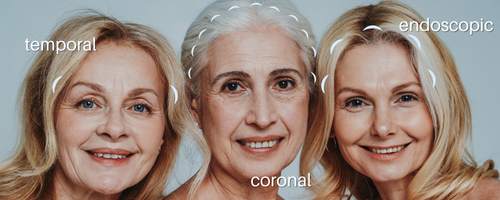 3 caucasian women with varying degrees of brow ptosis