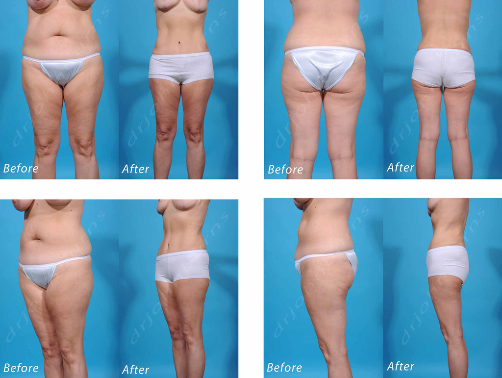 Liposuction Before and After Photo Gallery – Dr John Burns